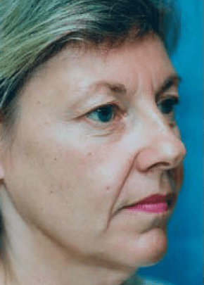 Facelift and Necklift Before & After Patient #1726