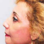 Facelift and Necklift Before & After Patient #1725