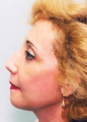 Facelift and Necklift Before & After Patient #1725