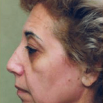 Facelift and Necklift Before & After Patient #1725