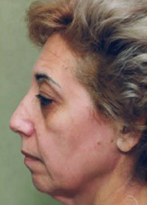 Facelift and Necklift Before & After Patient #1725