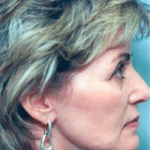 Facelift and Necklift Before & After Patient #1724