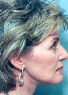 Facelift and Necklift Before & After Patient #1724