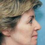 Facelift and Necklift Before & After Patient #1724