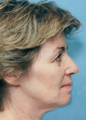 Facelift and Necklift Before & After Patient #1724