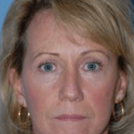Facelift and Necklift Before & After Patient #1723