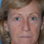Facelift and Necklift Before & After Patient #1723