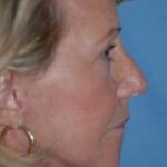 Facelift and Necklift Before & After Patient #1722
