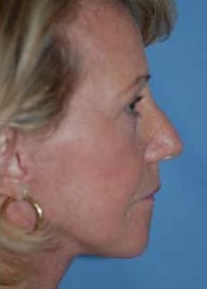 Facelift and Necklift Before & After Patient #1722