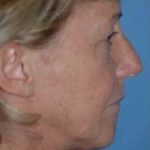 Facelift and Necklift Before & After Patient #1722