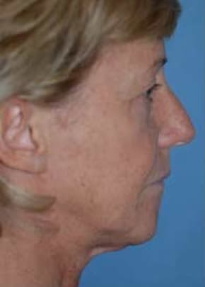 Facelift and Necklift Before & After Patient #1722