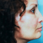 Facelift and Necklift Before & After Patient #1721