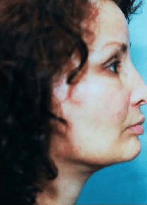Facelift and Necklift Before & After Patient #1721