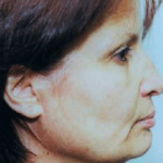 Facelift and Necklift Before & After Patient #1721