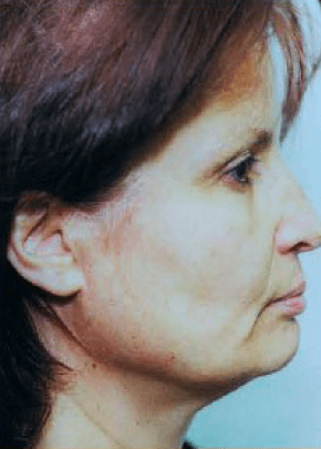 Facelift and Necklift Before & After Patient #1721