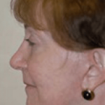 Facelift and Necklift Before & After Patient #1720