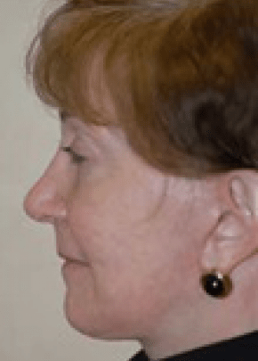 Facelift and Necklift Before & After Patient #1720