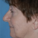 Facelift and Necklift Before & After Patient #1720