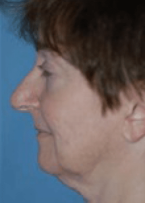 Facelift and Necklift Before & After Patient #1720