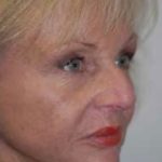 Facelift and Necklift Before & After Patient #1719