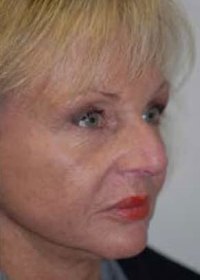 Facelift and Necklift Before & After Patient #1719