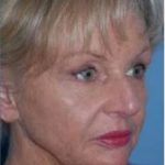 Facelift and Necklift Before & After Patient #1719