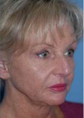 Facelift and Necklift Before & After Patient #1719