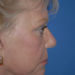 Facelift and Necklift Before & After Patient #1718