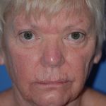 Facelift and Necklift Before & After Patient #1718