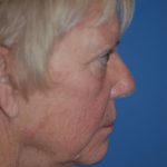 Facelift and Necklift Before & After Patient #1718