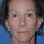Facelift and Necklift Before & After Patient #1717