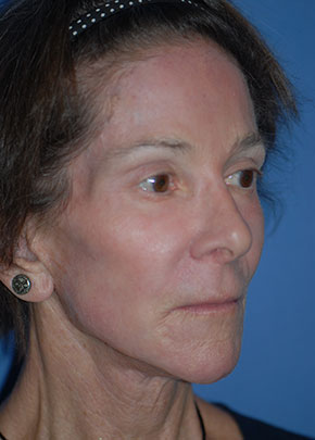 Facelift and Necklift Before & After Patient #1717