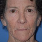 Facelift and Necklift Before & After Patient #1717