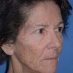 Facelift and Necklift Before & After Patient #1717