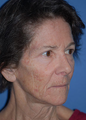 Facelift and Necklift Before & After Patient #1717