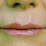 Fillers Before & After Patient #2071