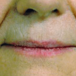 Fillers Before & After Patient #2071