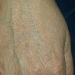 Fraxel Laser Before & After Patient #2093
