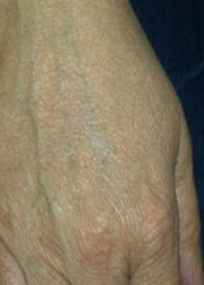 Fraxel Laser Before & After Patient #2093