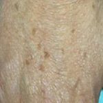Fraxel Laser Before & After Patient #2093