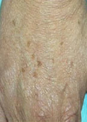 Fraxel Laser Before & After Patient #2093