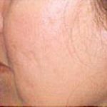 Fraxel Laser Before & After Patient #2092