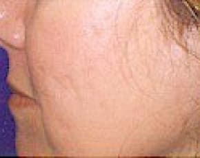 Fraxel Laser Before & After Patient #2092