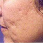 Fraxel Laser Before & After Patient #2092