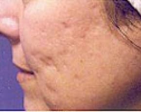 Fraxel Laser Before & After Patient #2092