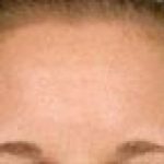 Fraxel Laser Before & After Patient #2091