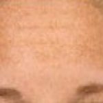 Fraxel Laser Before & After Patient #2091