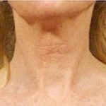 Fraxel Laser Before & After Patient #2090