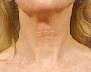 Fraxel Laser Before & After Patient #2090