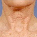 Fraxel Laser Before & After Patient #2090